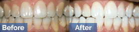 Before and after Zoom Teeth Whitening